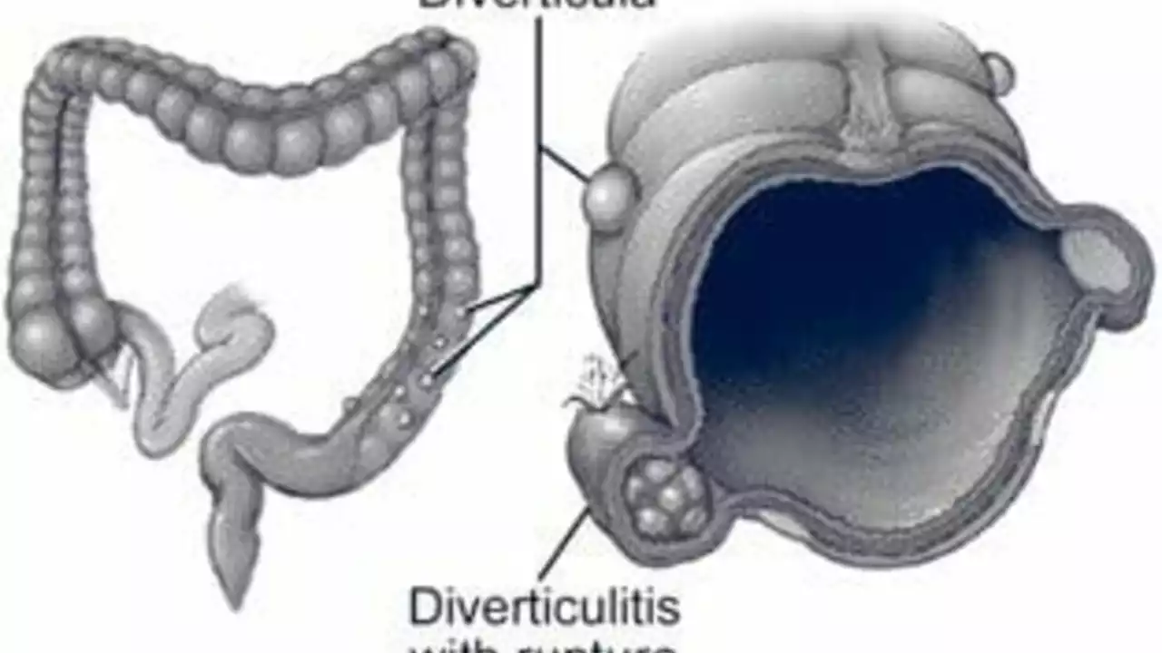 How to Manage Diverticulitis at Work