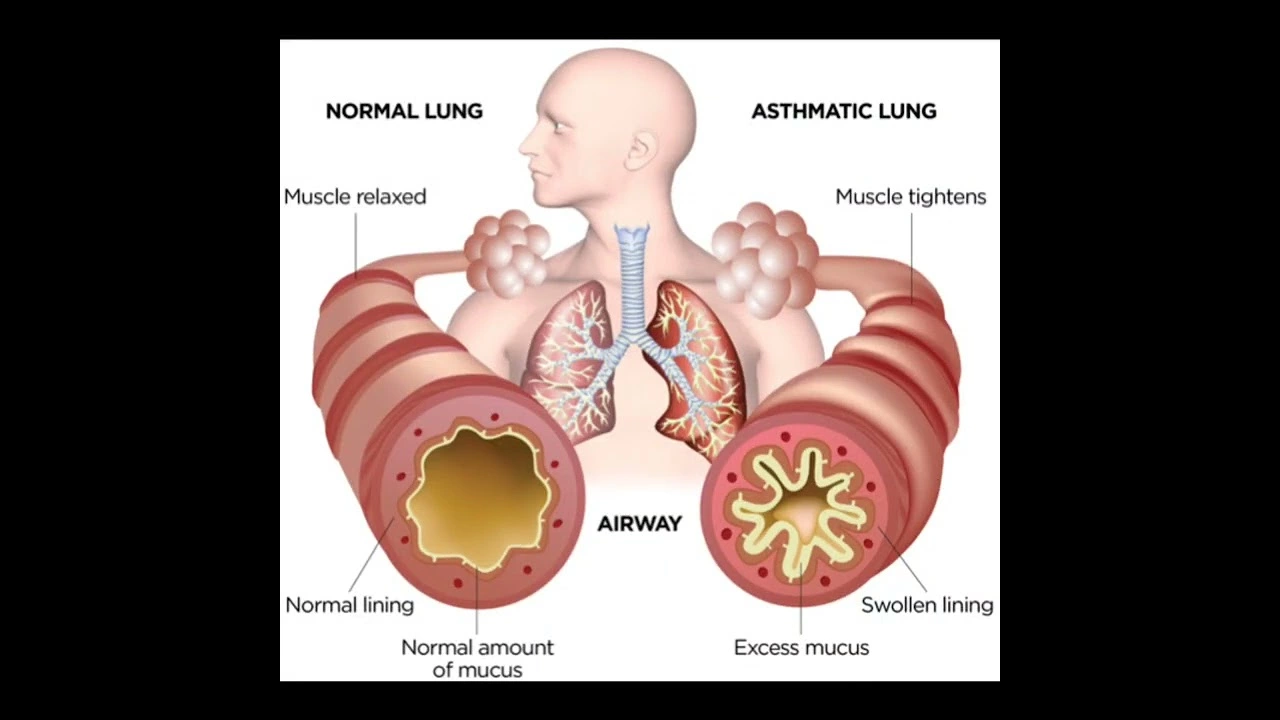 Montelukast and Asthma Education: A Winning Combination